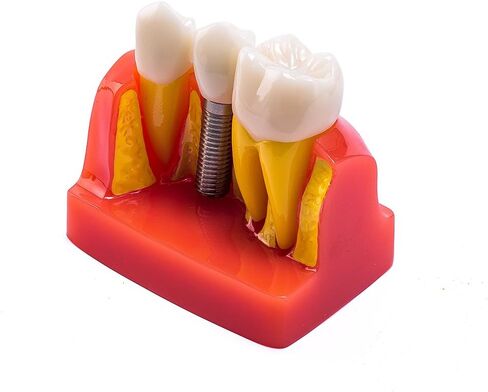 EASYTODENTA 4 مرات زرع نموذج لشكل الأسنان تحليل الأسنان جسر التاج مظاهرة نموذج لشكل الأسنان للتعليم والتواصل مع المرضى in Kuwait