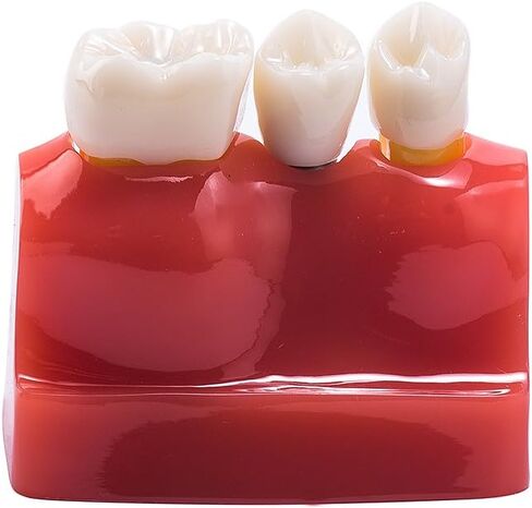 EASYTODENTA 4 مرات زرع نموذج لشكل الأسنان تحليل الأسنان جسر التاج مظاهرة نموذج لشكل الأسنان للتعليم والتواصل مع المرضى in Kuwait