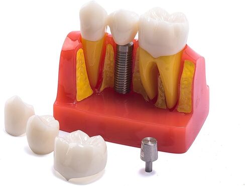 EASYTODENTA 4 مرات زرع نموذج لشكل الأسنان تحليل الأسنان جسر التاج مظاهرة نموذج لشكل الأسنان للتعليم والتواصل مع المرضى in Kuwait