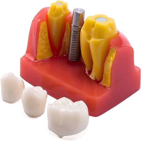 EASYTODENTA 4 مرات زرع نموذج لشكل الأسنان تحليل الأسنان جسر التاج مظاهرة نموذج لشكل الأسنان للتعليم والتواصل مع المرضى in Kuwait