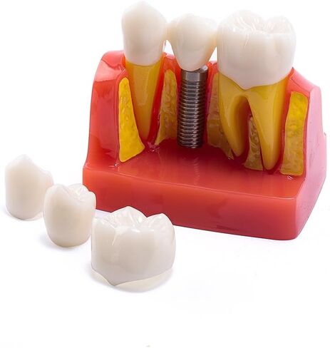 EASYTODENTA 4 مرات زرع نموذج لشكل الأسنان تحليل الأسنان جسر التاج مظاهرة نموذج لشكل الأسنان للتعليم والتواصل مع المرضى in Kuwait