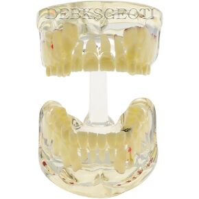 Dental Model Kids Pediatric Teeth Typodont with Caries, Cyst, and Firstula, It Demonstrates The Developing Dentition of Age 6-9 Children (M4002)