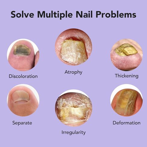 علاج الأظافر الفطري قوة إضافية ، وعلاجات أظافر الصبغة للأظافر السميكة والأصفر والمتحلل ، و 30 مل ل 4 أسابيع من الفطريات الأظافر ، وأظافر الأظافر ، والرياضيين ، ونمو الأظافر و "القويتر" in Kuwait