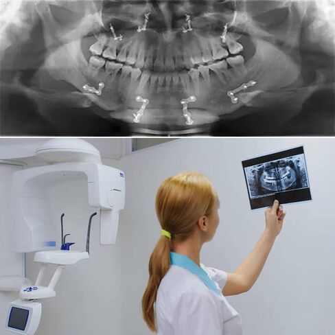 Dental X-Ray Film Positioning System Complete Kit - FPS 3000 Universal Intraoral Positioner Holders in Kuwait