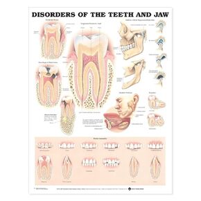 Disorders of the Teeth and Jaw Anatomical Chart