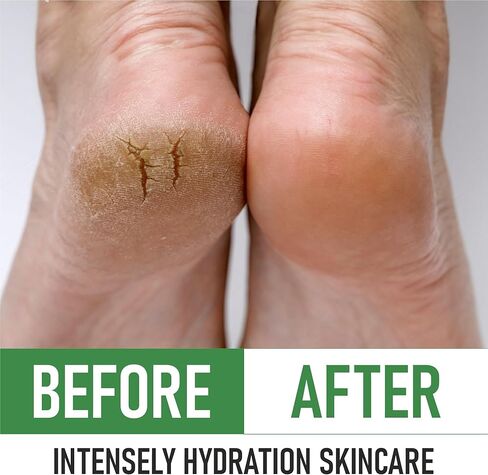 PurOrganica Urea 20% Healing Cream 4 oz - Best Callus Remover - Moisturizes and Rehydrates Hands, Feet and Knees to a Healthy Appearance - Soothes and Softens Thick, Cracked, Rough Dead and Dry Skin in Saudi Arabia