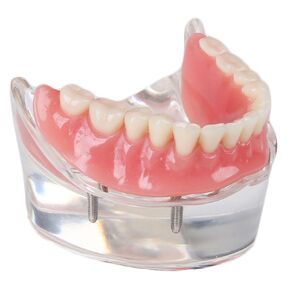 SOARDAY Dental Restoration Model with 4 implants Overdenture Inferior Teaching Study Teeth Model